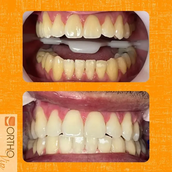 Antes e depois: Clareamento dental