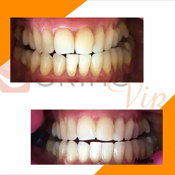 Antes e depois: Clareamento de consultório