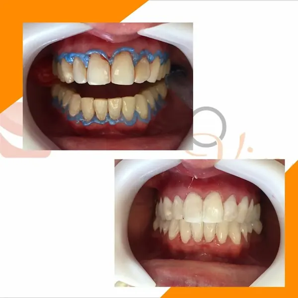 Antes e depois: Clareamento: resultado da primeira sessão