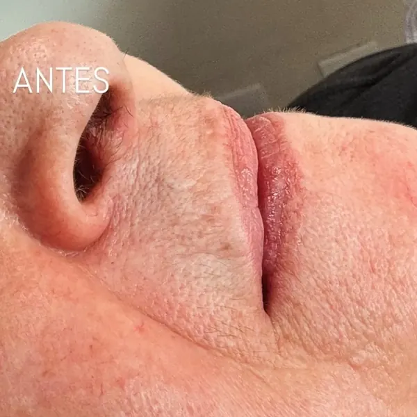 Antes: Preenchimento labial com ácido hialurônico (1 ml)