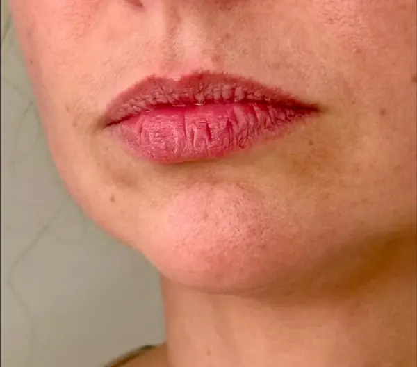 Antes: Preenchimento labial: contorno e definição