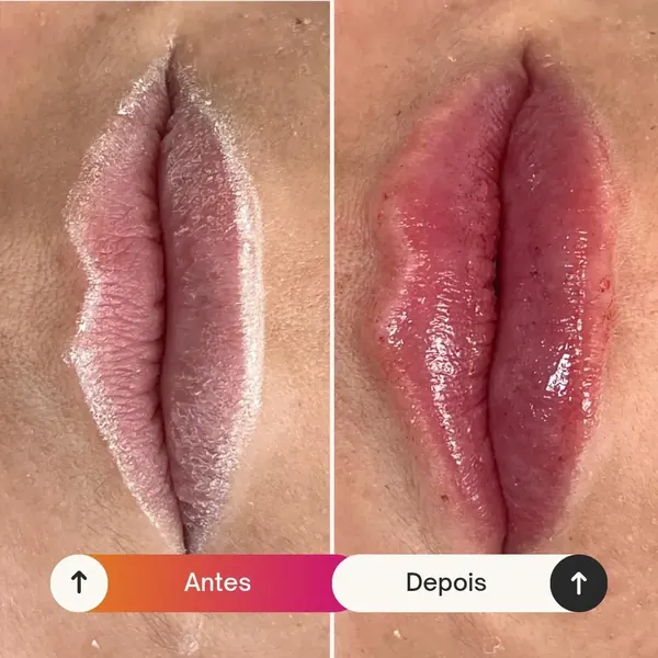 Antes e depois: Preenchimento labial com desenho proporcional
