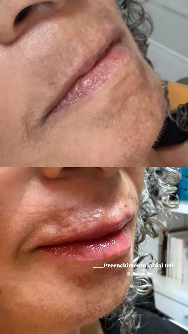 Antes e depois: Preenchimento labial