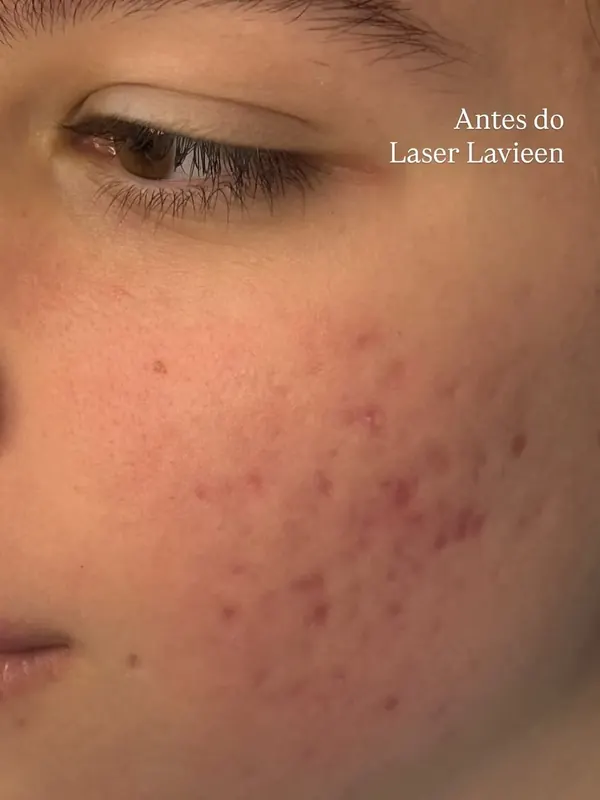 Antes: Laser Lavieen para textura e qualidade da pele