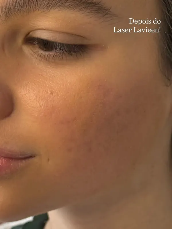Depois: Laser Lavieen para textura e qualidade da pele