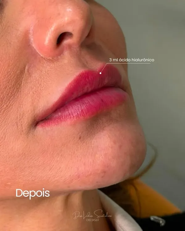 Depois: Preenchimento labial: contorno e volume