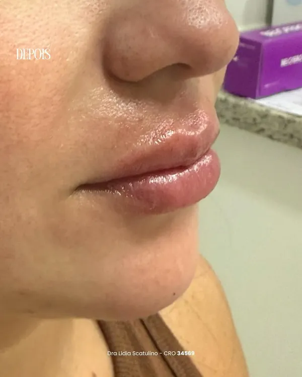 Depois: Preenchimento labial e projeção do queixo