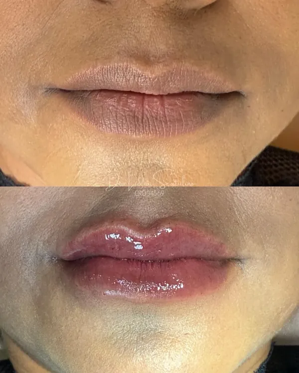 Antes e depois, de frente: Preenchimento labial: contorno, volume e simetria