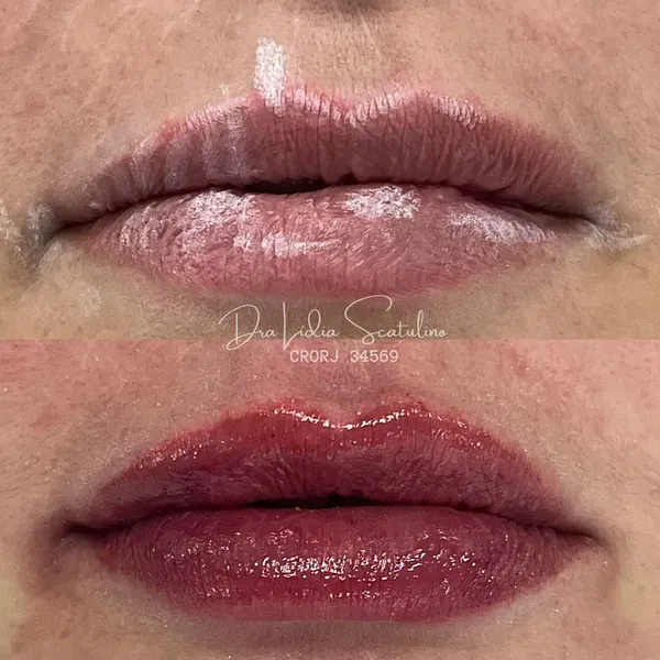Antes e depois: Preenchimento labial para equilibrar a assimetria