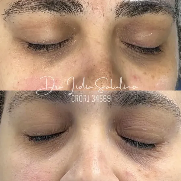 Antes e depois: Peeling para olheiras