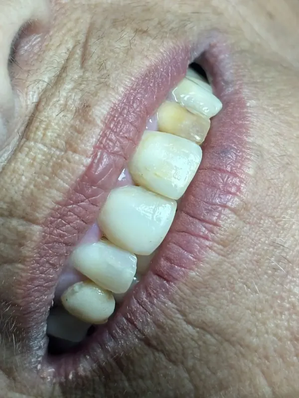 Antes: Facetas em resina: forma, cor e brilho