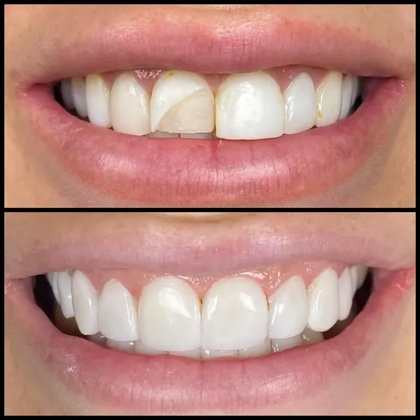 Antes e depois: Substituição de facetas de resina antigas
