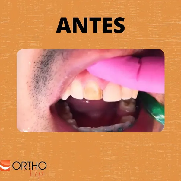Antes: Lente de contato em dente escurecido após canal