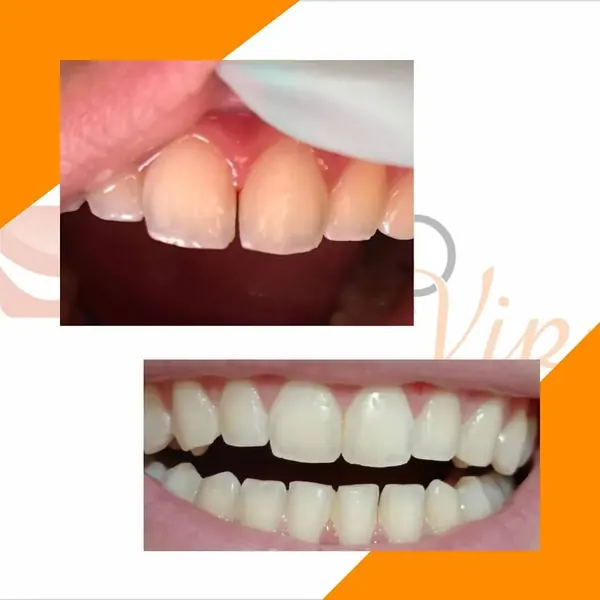 Antes e depois: Fechamento de diastema com resina