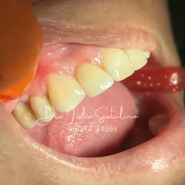 Depois: Fechamento de diastema lateral com resina