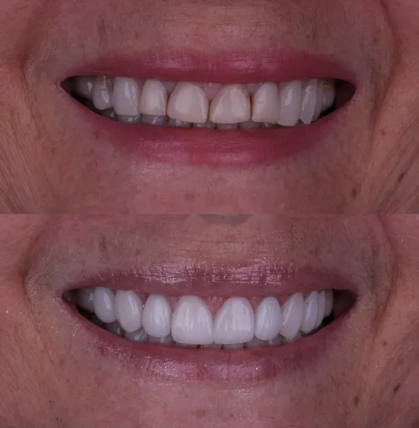 Antes e depois: Lentes de contato dental