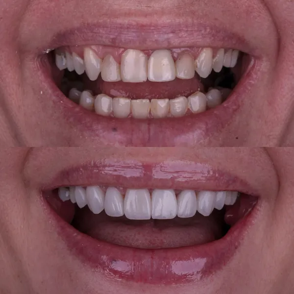 Antes e depois: Lentes de contato dental