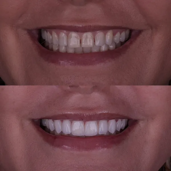 Antes e depois: Lentes de contato dental