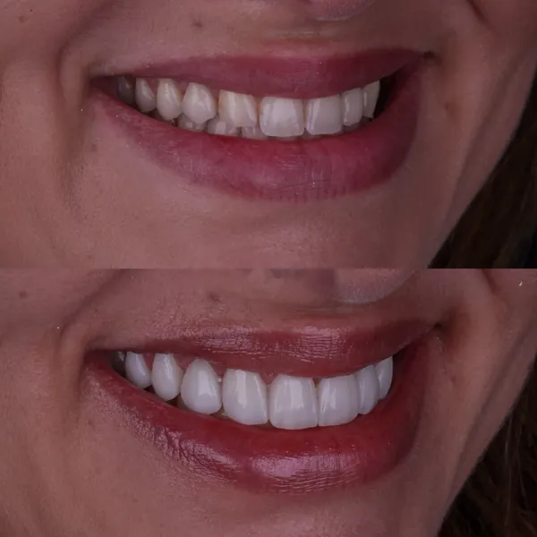 Antes e depois: Lentes de contato dental