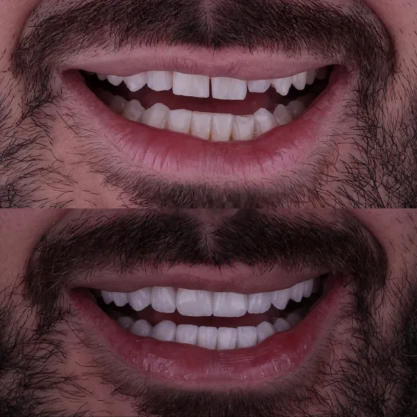 Antes e depois: Lentes de contato dental