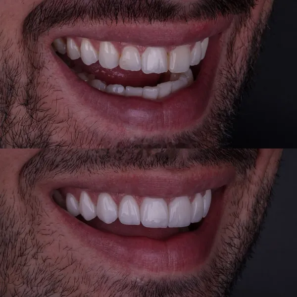 Antes e depois: Lentes de contato dental