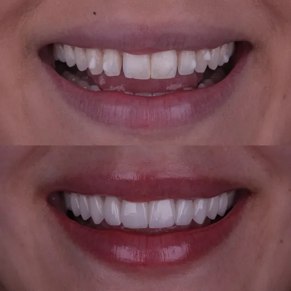 Antes e depois: Lentes de contato dental
