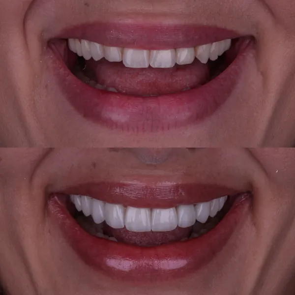 Antes e depois: Lentes de contato dental