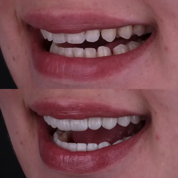 Antes e depois: Lentes de contato dental