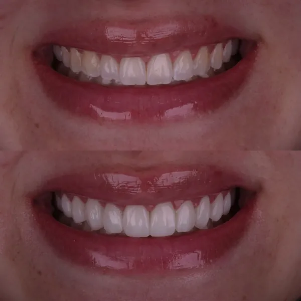 Antes e depois: Lentes de contato dental