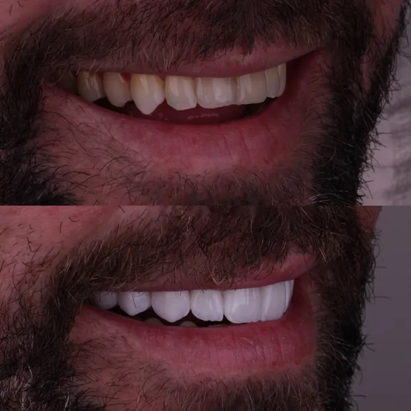 Antes e depois: Lentes de contato dental