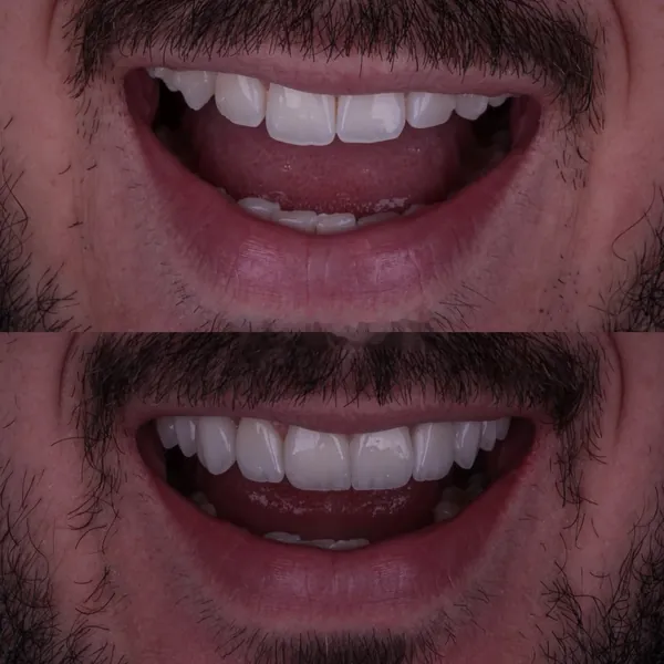Antes e depois: Lentes de contato dental