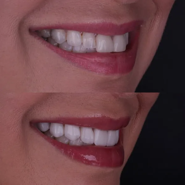Antes e depois: Lentes de contato dental