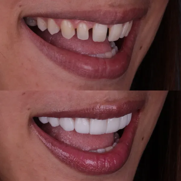 Antes e depois: Lentes de contato dental