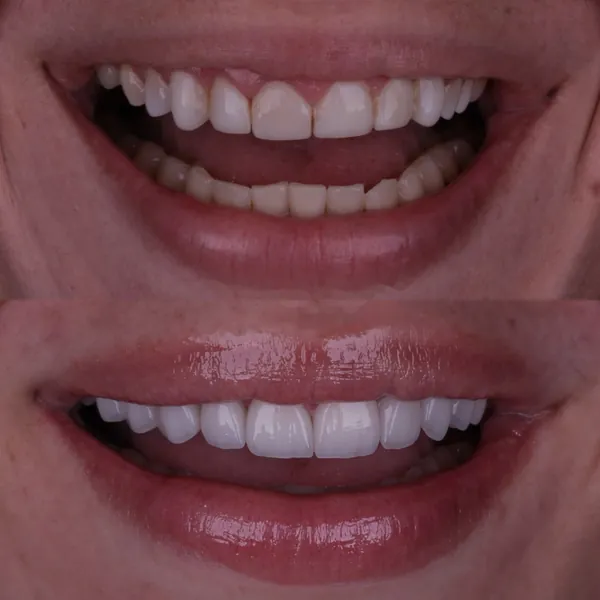 Antes e depois: Lentes de contato dental