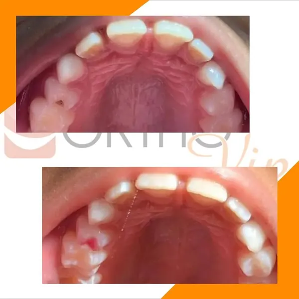 Antes e depois: Restauração com resina colorida em dente de leite