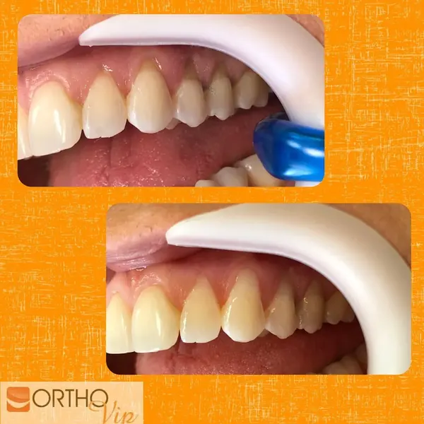 Antes e depois: Restauração de desgaste por abrasão