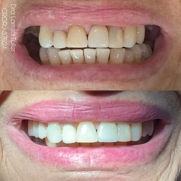 Antes e depois: Prótese parcial removível