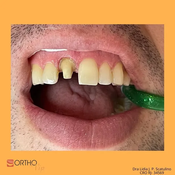 Antes: Coroa total em dente com canal tratado