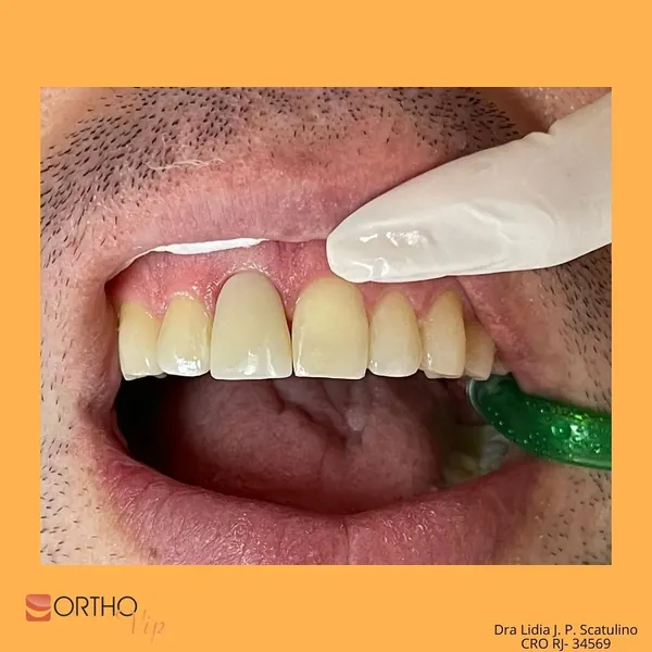 Depois: Coroa total em dente com canal tratado